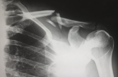 Find Your Perfect Personal Injury Leads Partner!